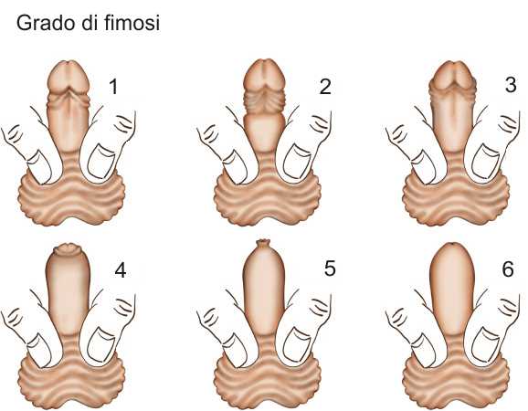 classificazione fimosi grado